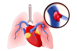 Pulmonary-embolism