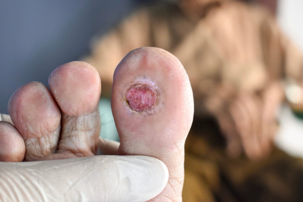 Diabetic Ulcer On Toe