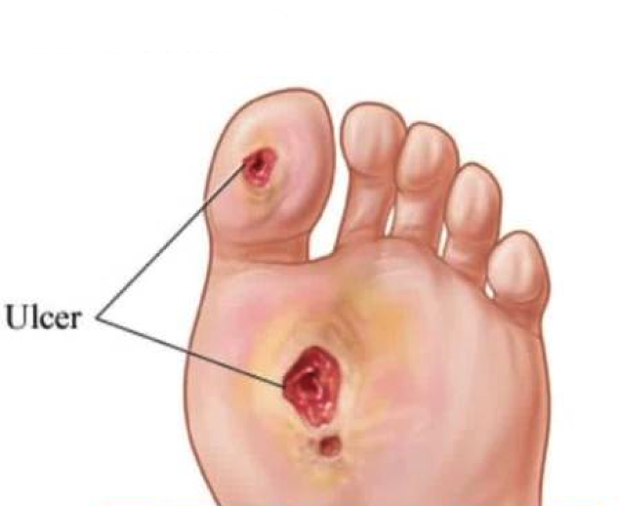 Diabetic-Foot-Ulcer