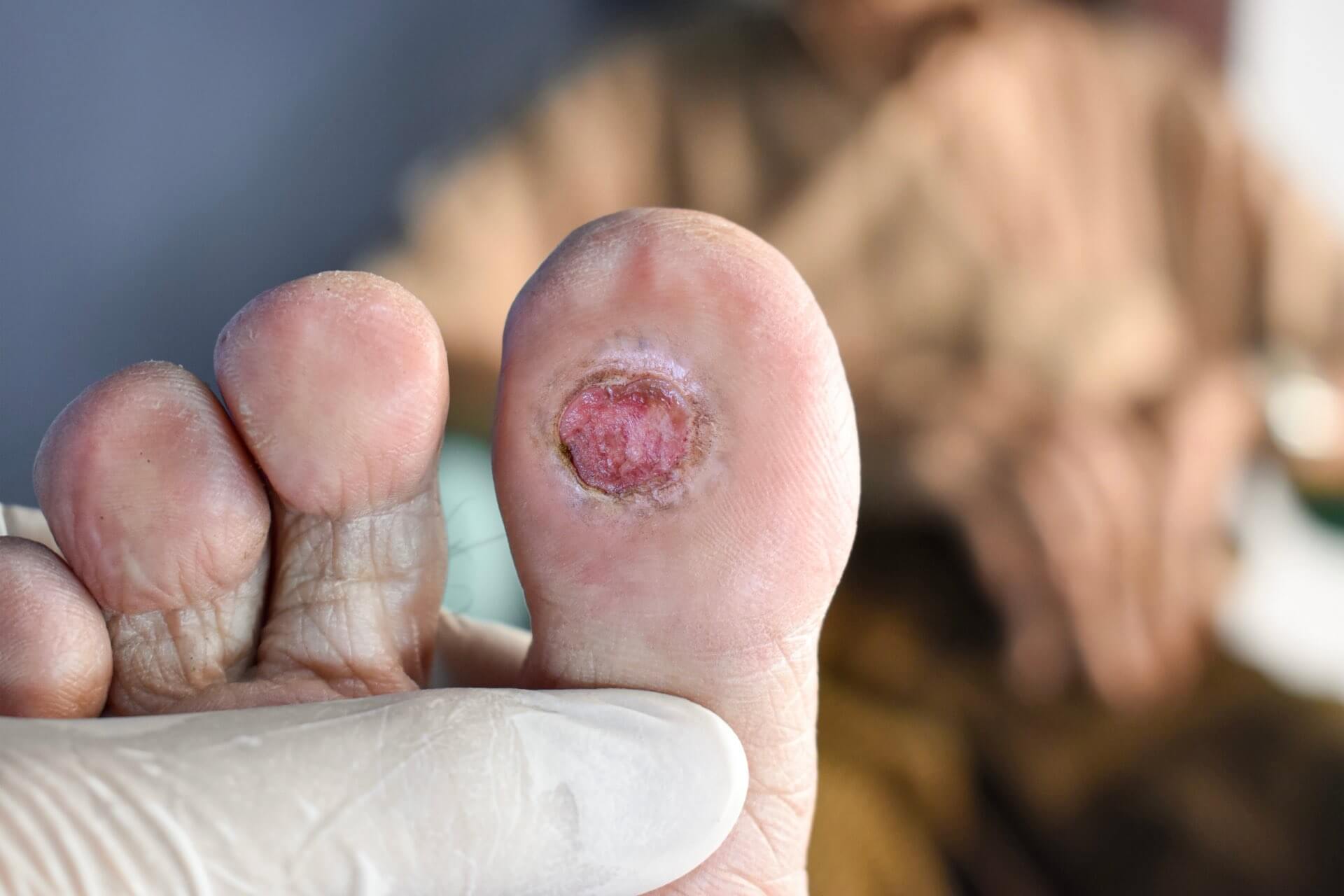Diabetic Foot Ulcer Treatment At Anwar Laboratories Diabetic Foot Ulcer Treatment At Anwar Laboratories
